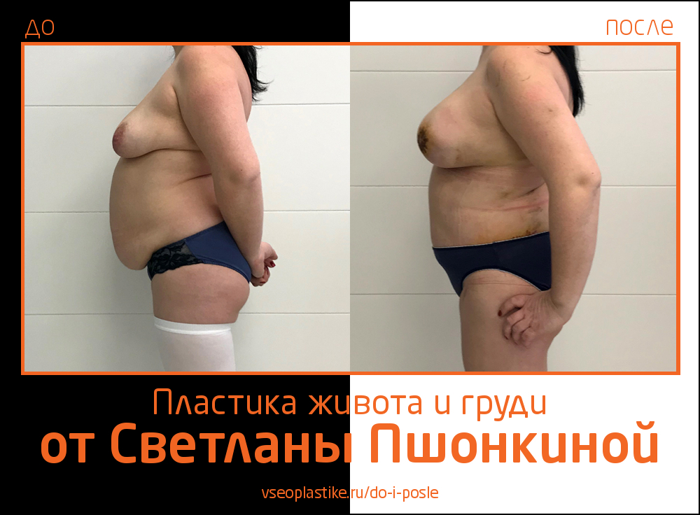 Светлана Пшонкина. Фото до и после абдоминопластики и пластики груди