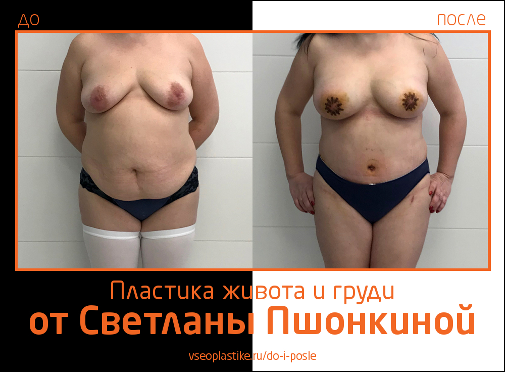 Светлана Пшонкина. Фото до и после абдоминопластики и пластики груди