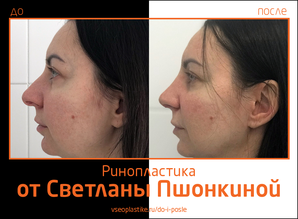 Светлана Пшонкина ринопластика