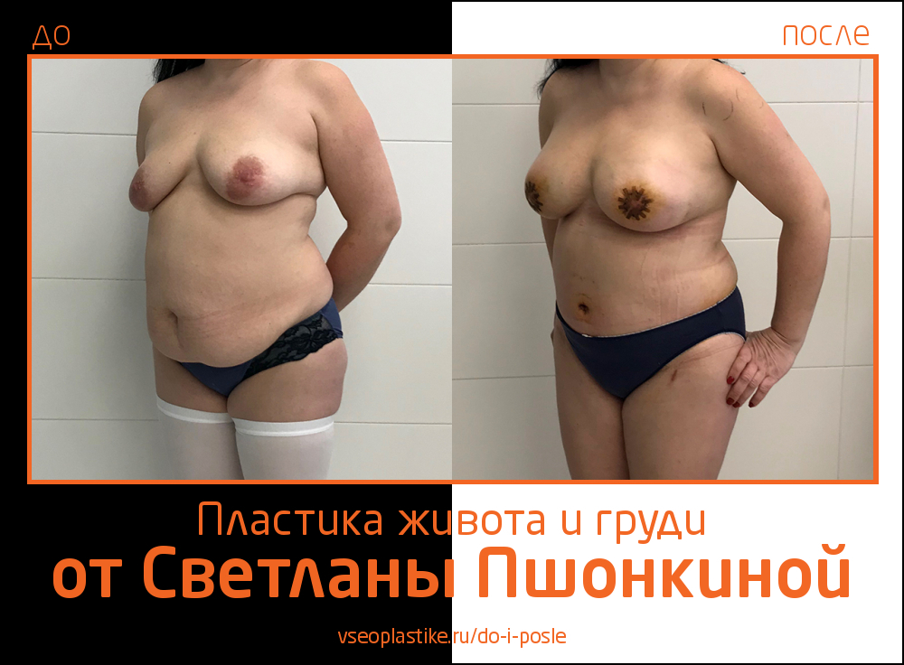 Светлана Пшонкина. Фото до и после абдоминопластики и пластики груди