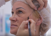 Сочетание нитевого и радиочастотного лифтинга лица
