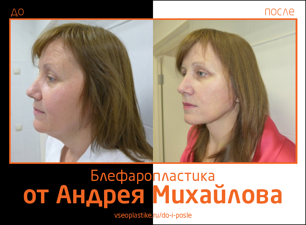 Андрей Михайлов. Фото до и после блефаропластики