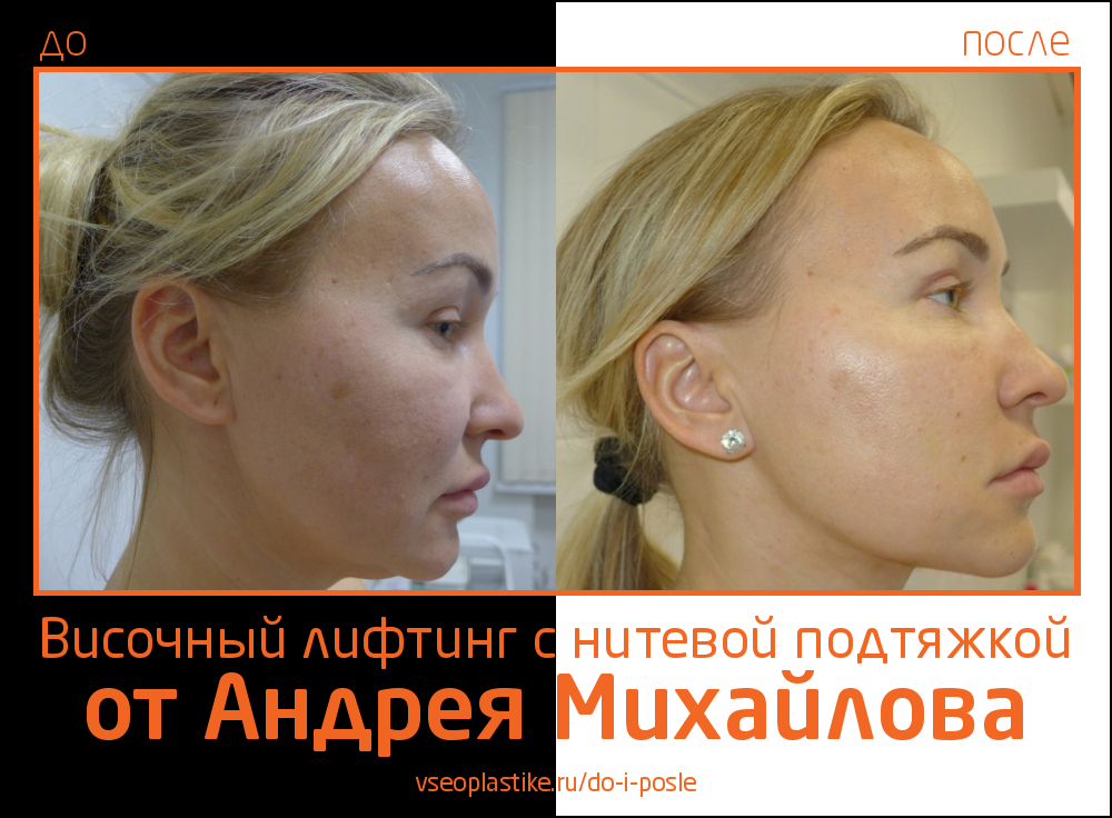 Пациентке был выполнен височный лифтинг и нитевая подтяжка