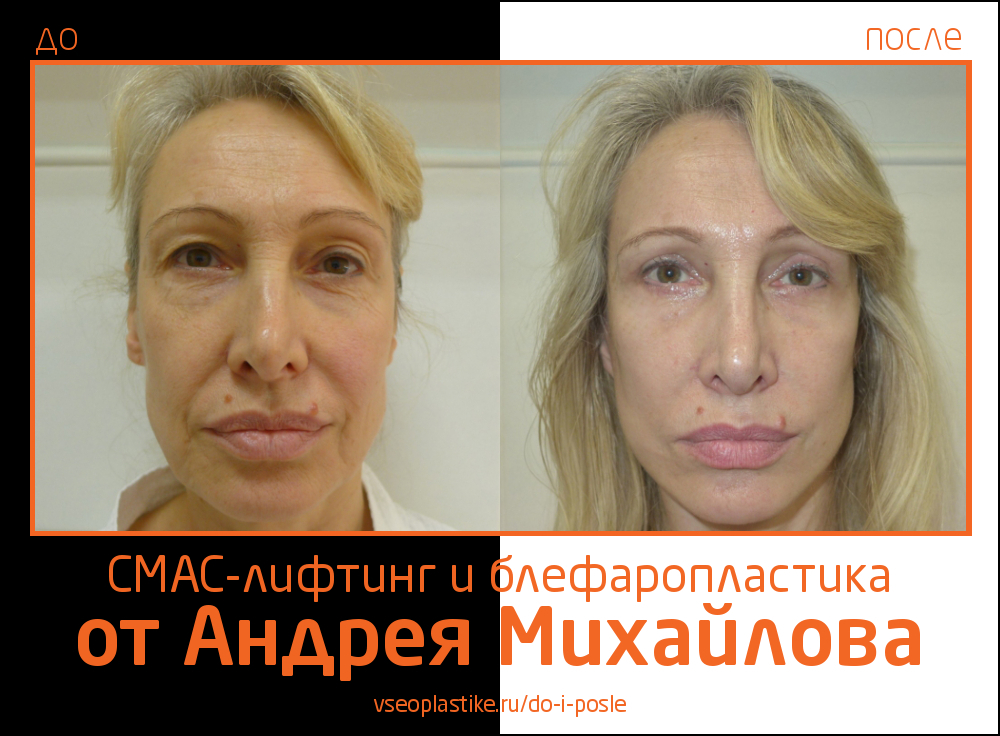 Пациентке была выполнена малоинвазивная подтяжка лица нитями, в результате которой женщина получила естественный эффект омоложения.