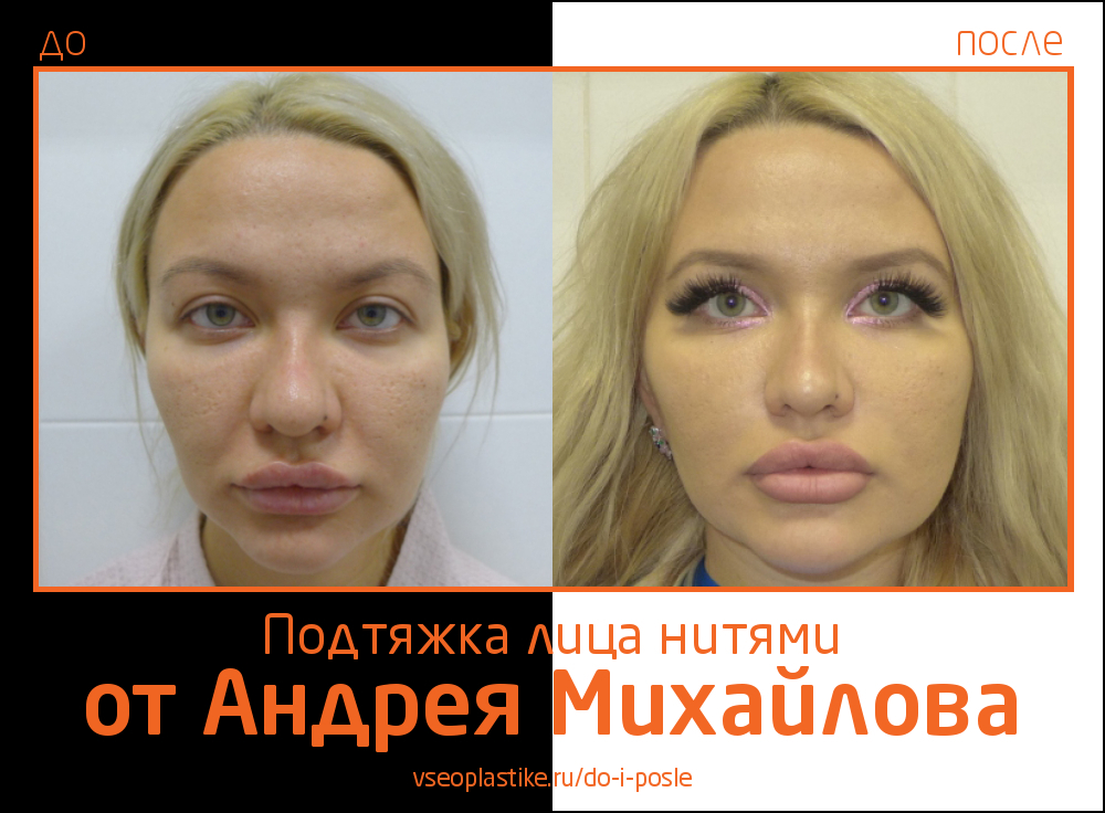 Пациентке была выполнена малоинвазивная подтяжка лица нитями, в результате которой женщина получила естественный эффект омоложения.