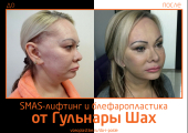 Гульнара Шах. Фото до и после SMAS-лифтинга и блефаропластики