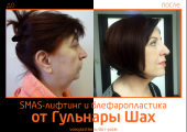 Гульнара Шах. Фото до и после SMAS-лифтинга и блефаропластики