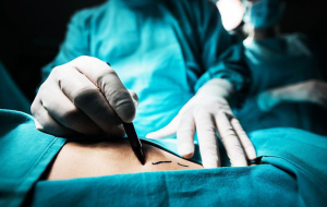 Расширенная абдоминопластика