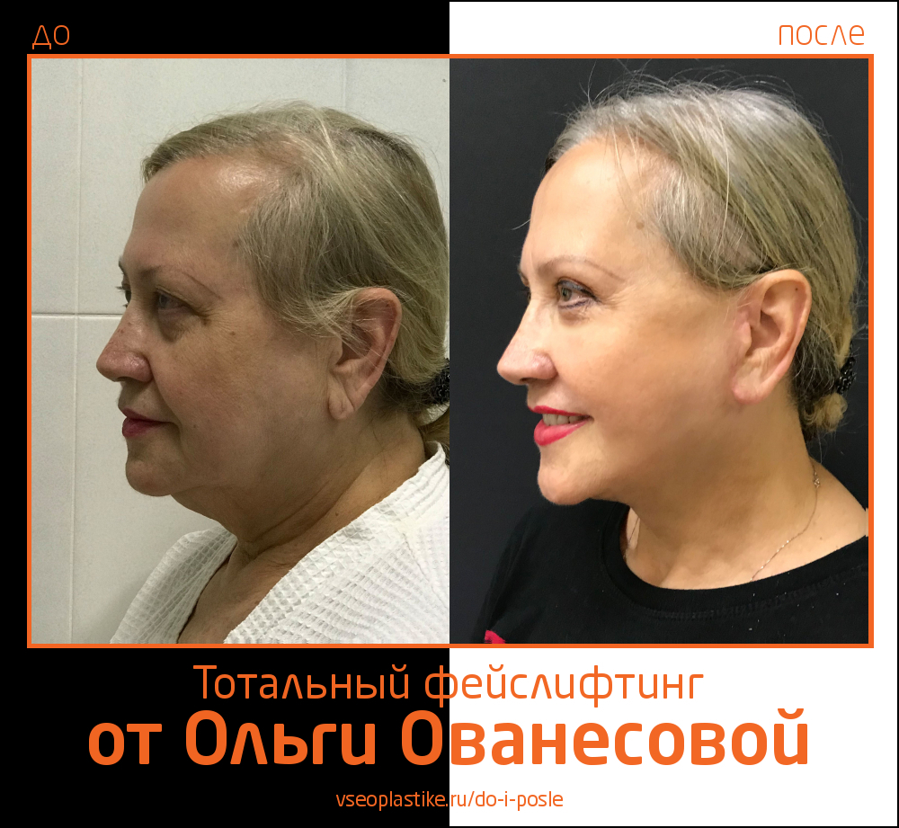 Ольга Ованесова. Фото до и после тотального омоложения лица