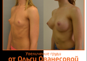 Результаты органосохраняющей операции по увеличению молочных желез