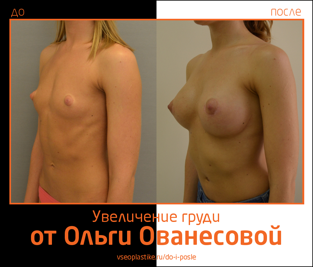 Результаты органосохраняющей операции по увеличению молочных желез