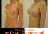 Пример восстановления формы груди после родов и кормления