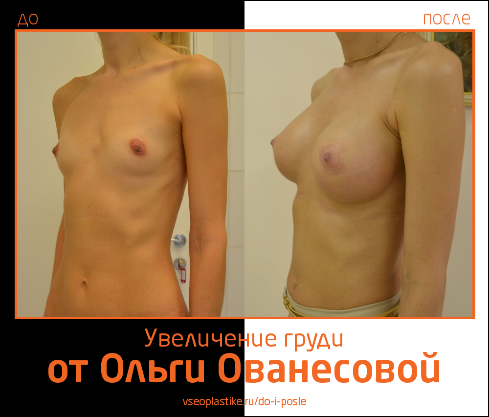 Пример восстановления формы груди после родов и кормления
