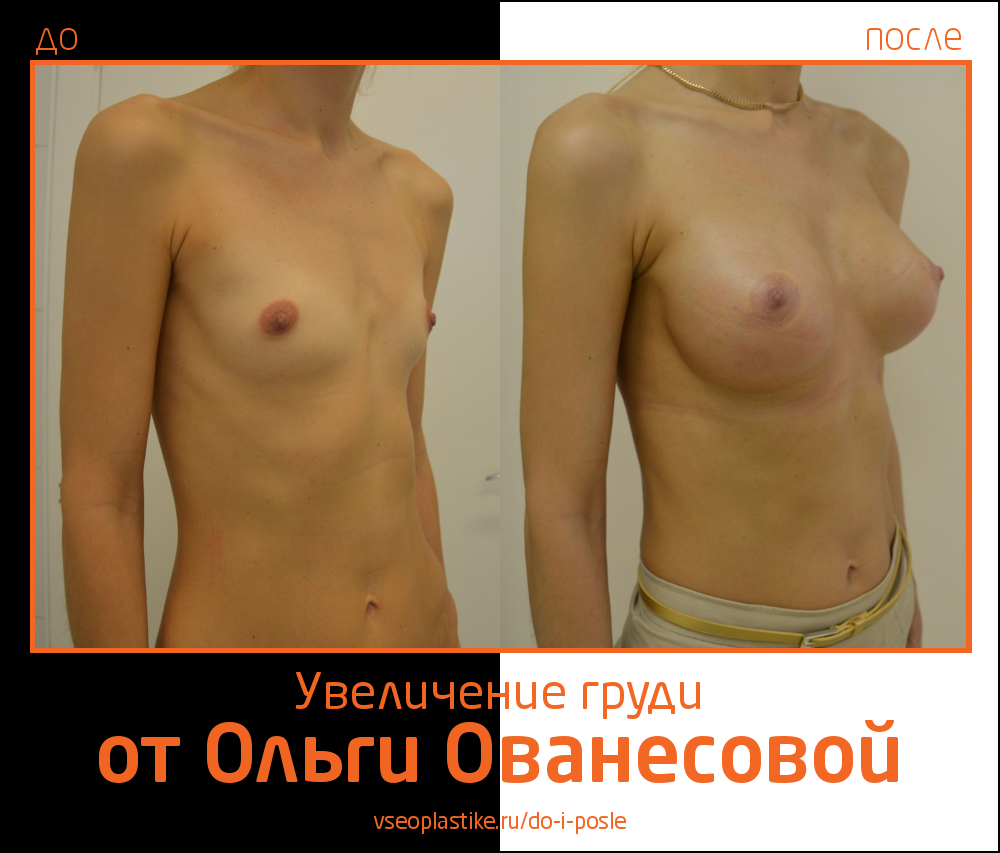 Пример восстановления формы груди после родов и кормления