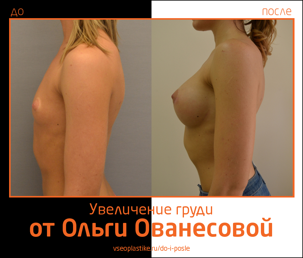 Результаты органосохраняющей операции по увеличению молочных желез