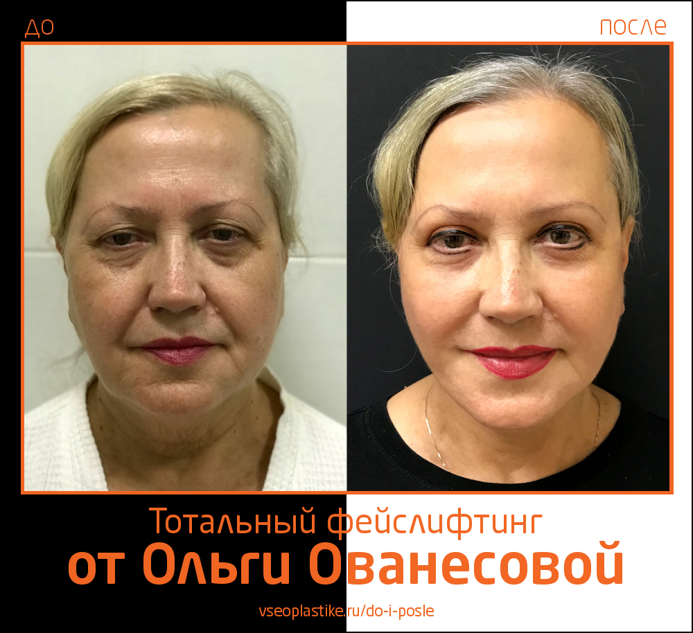 Ольга Ованесова. Фото до и после тотального омоложения лица