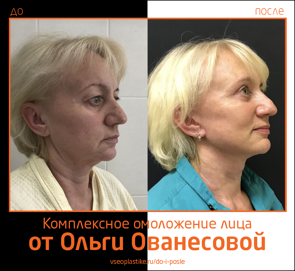 Ольга Ованесова. Фото до и после комплексного омоложения лица