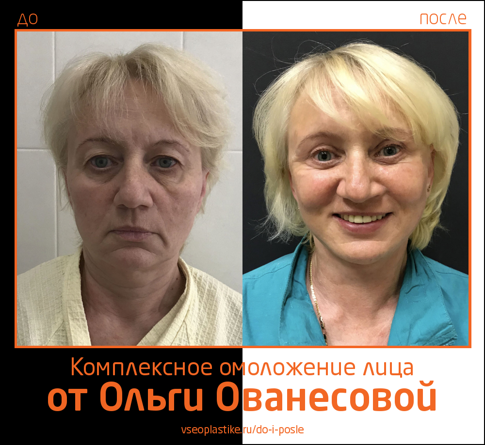 Ольга Ованесова. Фото до и после комплексного омоложения лица