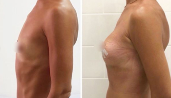 Рустем Каримов увеличение груди