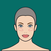 Лицевые импланты