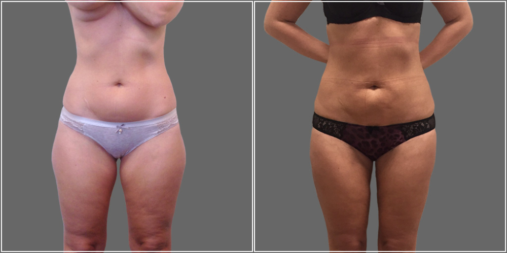 Радиочастотная липосакция пшонкина