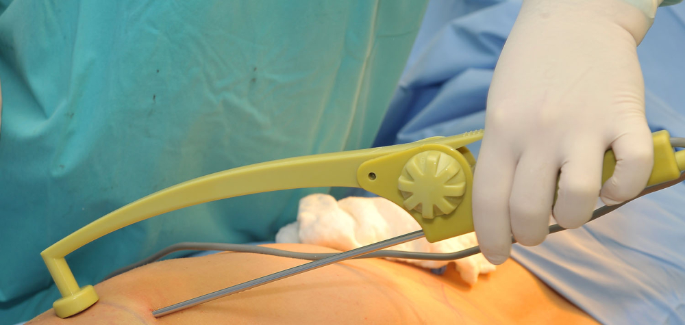 Радиочастотная липосакция