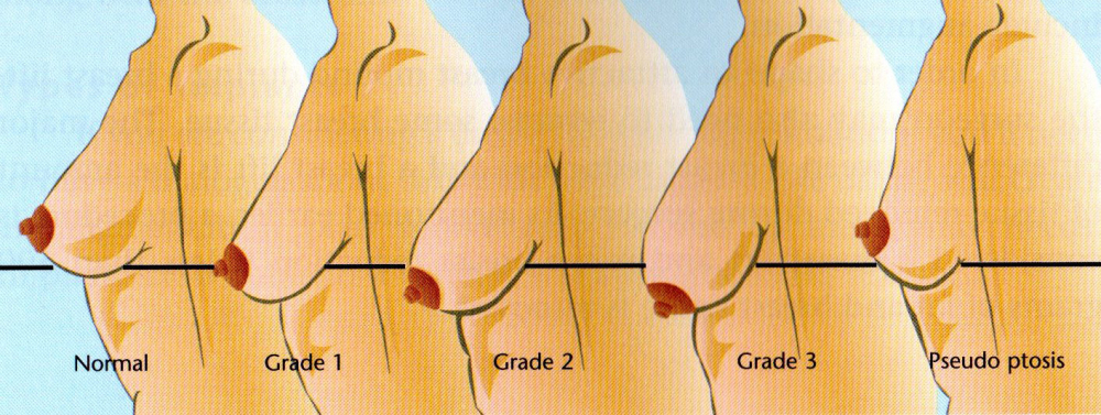 Степени птоза груди