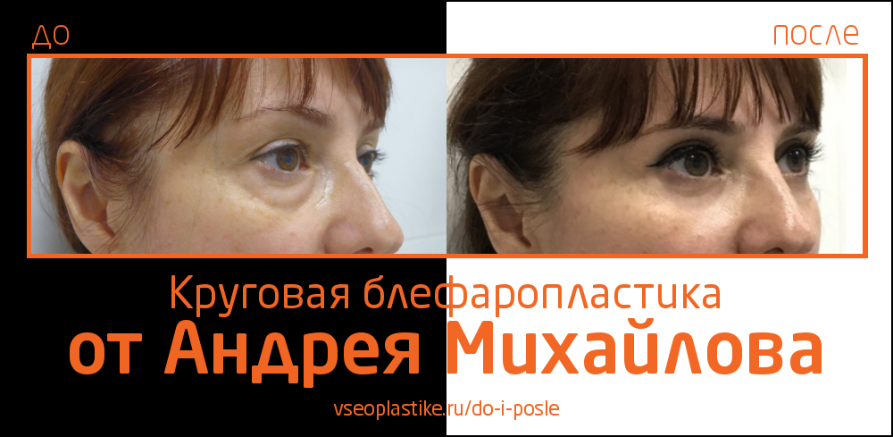 Андрей Михайлов. Фото до и после блефаропластики