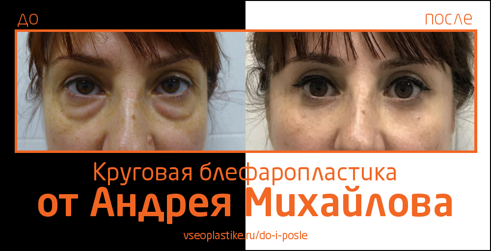 Андрей Михайлов. Фото до и после блефаропластики