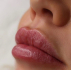 История пациента о липофилинге губ у доктора Яны Кизюн