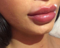 Липофилинг губ у пластического хирурга Яны Кизюн