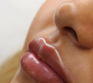 Мой отзыв на липофилинг губ у пластического хирурга Яны Кизюн