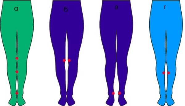 Классификация кривизны ног
