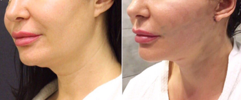 Фархат Мамедов подтяжка лица