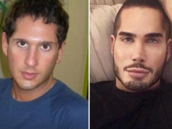 Йен Старр Калатцис до и после пластики