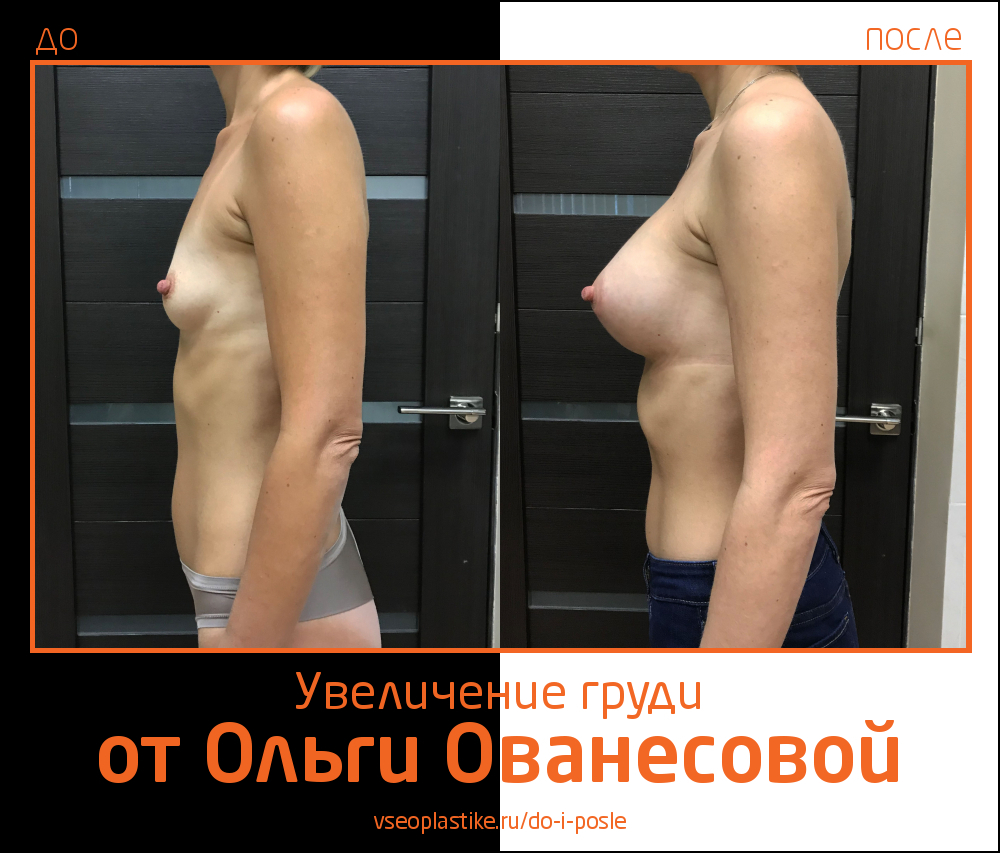 Ольга Ованесова. Увеличение груди