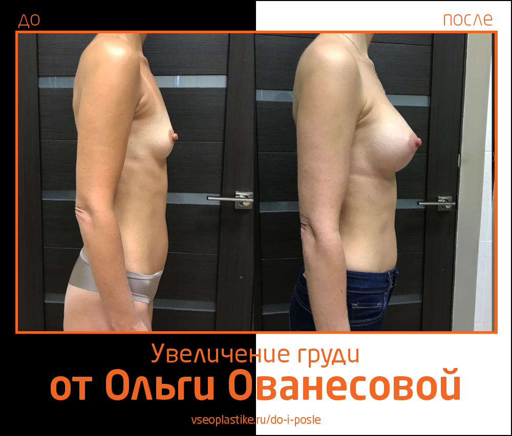 Ольга Ованесова. Увеличение груди