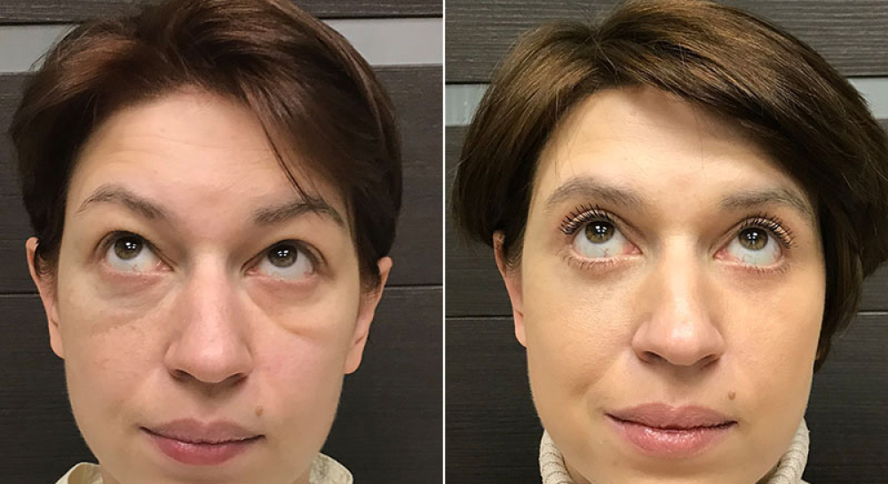 Круговая блефаропластика и липомоделирование малярной области