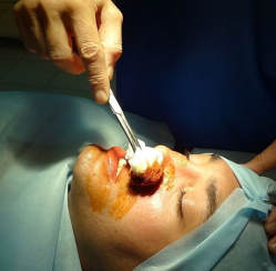 Пластический хирург Гайк Бабаян о ринопластике