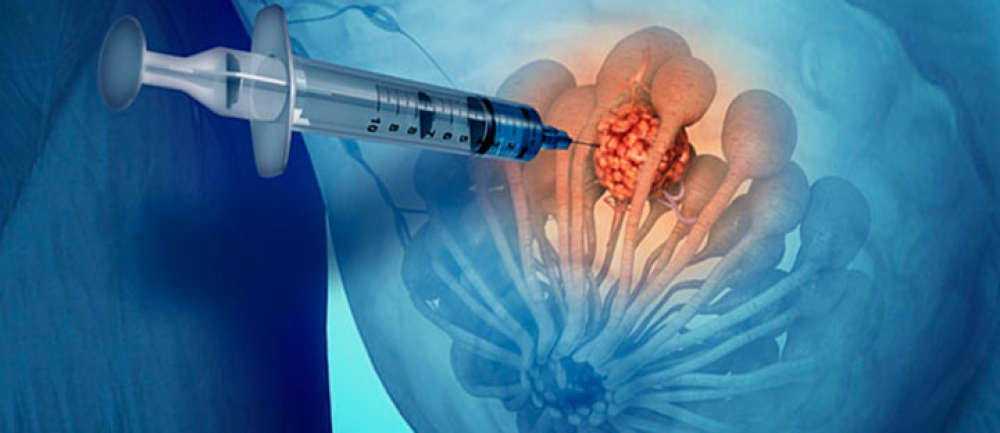 Пункция молочной железы