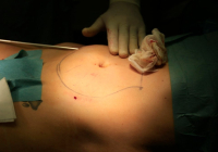 Липосакция под местной анестезией