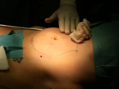 Липосакция под местной анестезией