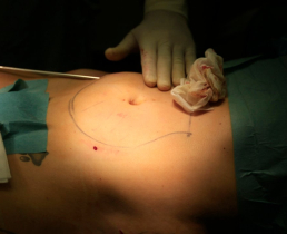 Липосакция под местной анестезией