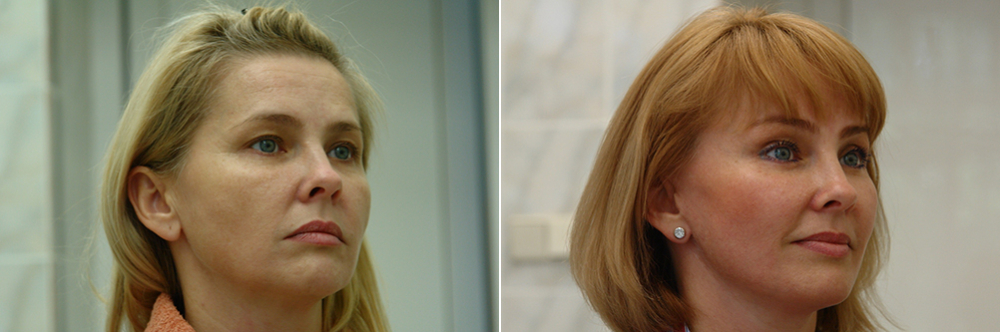 Тотальный лифтинг лица: эндоскопия лба, средней зоны лица, блефаропластика нижних век, СМАС-лифтинг лица