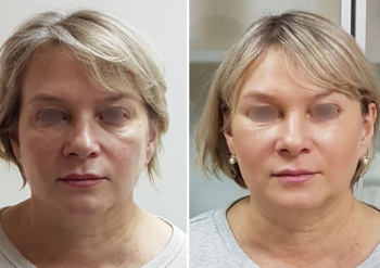 Блефаропластика височный лифтинг Рустем Каримов