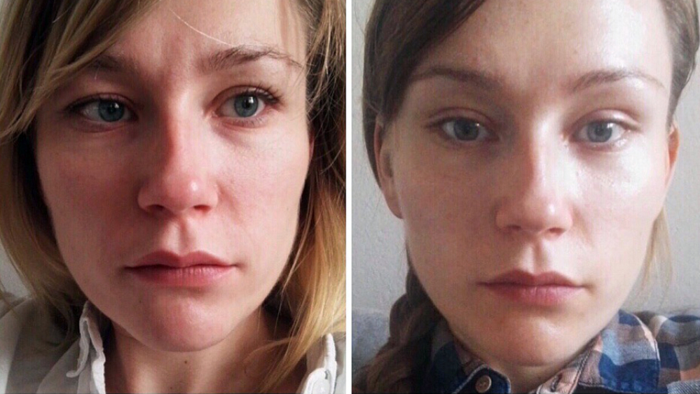 Блефаропластика и височный лифтинг Рустем Каримов