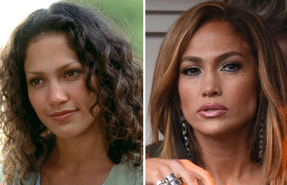 Ринопластика Дженнифер Лопес