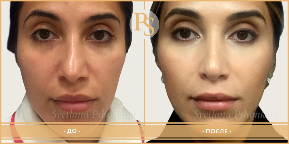 Фото до и после повторной ринопластики у Светланы Пшонкиной