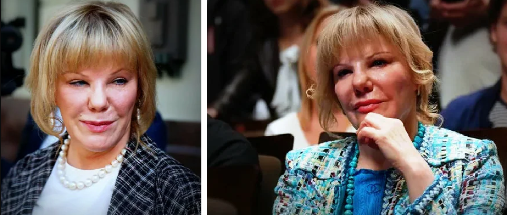 Александра Захарова после пластической операции