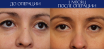 Фото «до и после» верхней блефaропластики